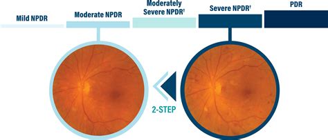 Diabetic Retinopathy Eylea® Aflibercept Injection