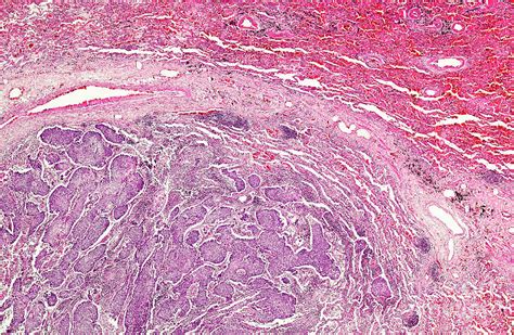 Squamous Cell Carcinoma Of The Lung Photograph By Nigel Downerscience