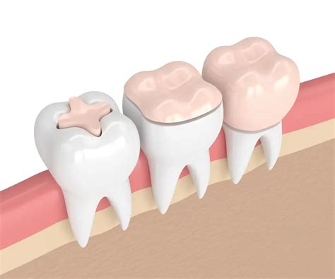 Dental Inlays and Onlays: What Is the Difference? | Byte®