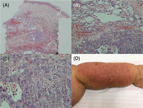 Unsuspected Stewarttreves Syndrome Clinically Mimicked By Apparent