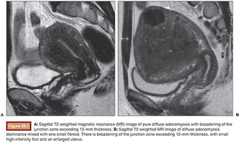 Adenomyosis Uterus MRI