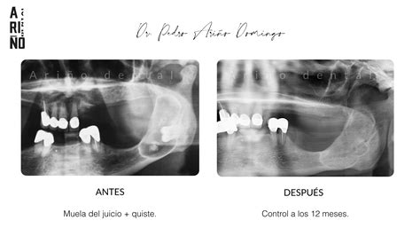 Casos clínicos Periodoncista Madrid ARIÑO dental