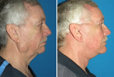 Facelifts For Men Richmond Va Men S Cosmetic Facial Surgery