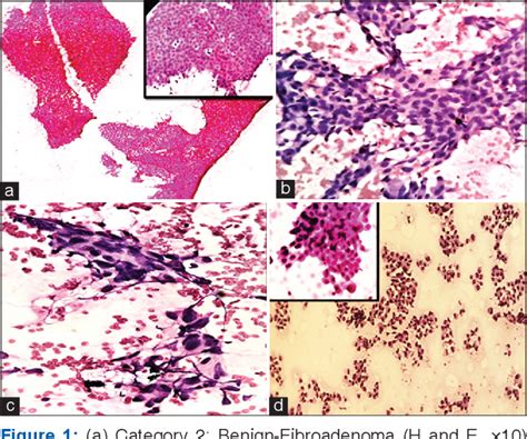 Figure 1 From Breast Fine Needle Aspiration Cytology Reporting Using