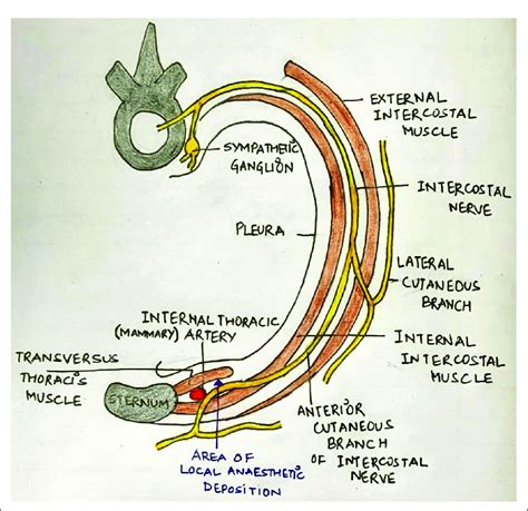 Sketch Diagram Illustrating The Transversus Thoracic Muscle Plane