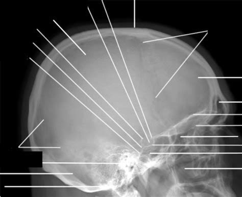 Radiography Of The Vault Bones Diagram Quizlet