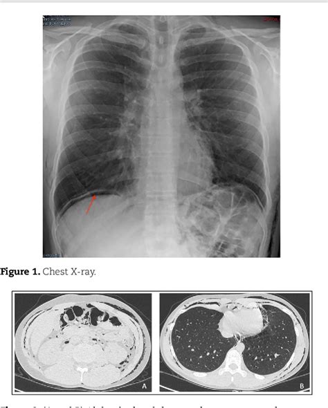 Figure From A Case Of Massive Subcutaneous Emphysema And Transient