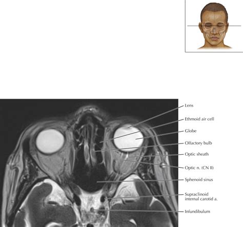 Olfactory Nerve Mri