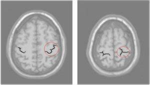 Central Sulcus - Definition, Location (MRI) and Function - (updated in ...