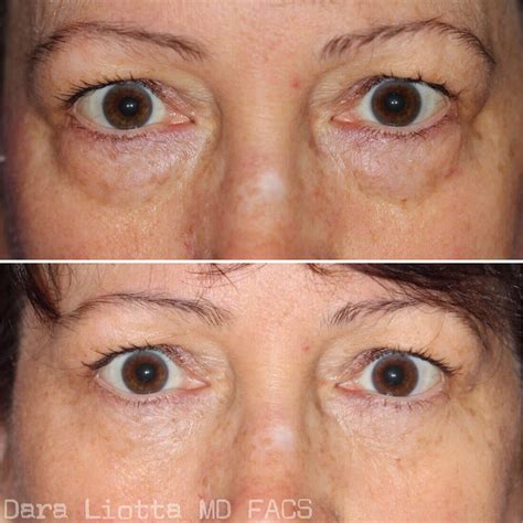 Eyelid Surgery Archives Dr Dara Liotta