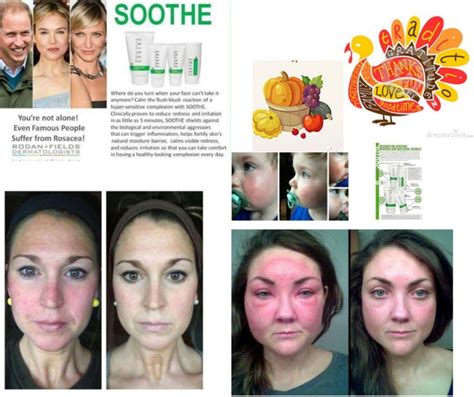 Soothe For Sensitive Irritated Skin And Facial Redness Calms Relieves