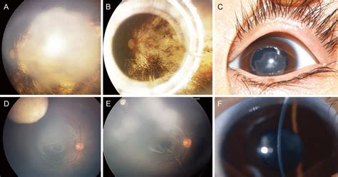 Representative Fundus Photographs And Anterior Segment Photographs