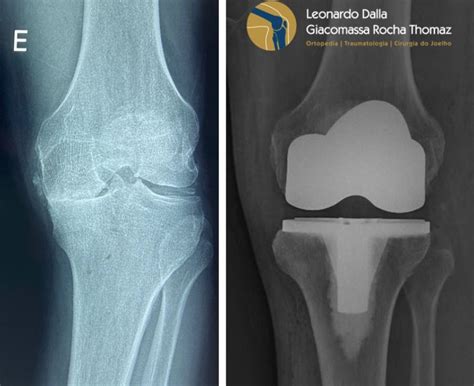 Prótese de Joelho Dr Leonardo Rocha Thomaz