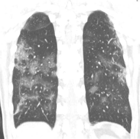 Cas Clinique De Pneumopathie Infectieuse Par SARS Cov 2 COVID 19