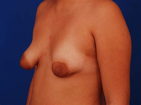 Puffy And Malformed Tits Lovely Areolas Plastic Surgery Porn Gallery