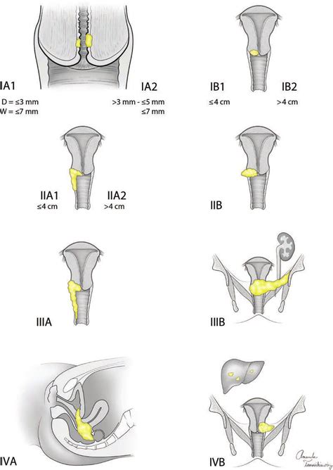 Cervical Cancer – Dr. Abdu