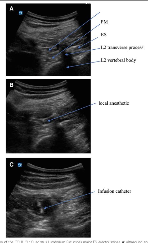 Ultrasound Guided Continuous Quadratus Lumborum Block Hastened Recovery