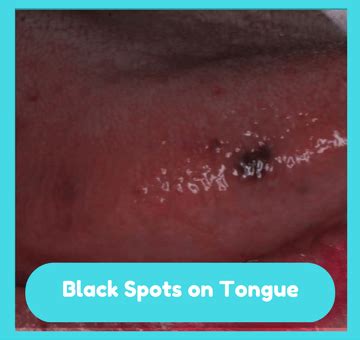 Black Spots on Tongue, Tiny, Small, Dark, Tip, Under, STD, Sides ...