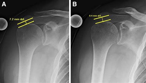 Clinical And Imaging Outcomes After Arthroscopic Superior Capsule