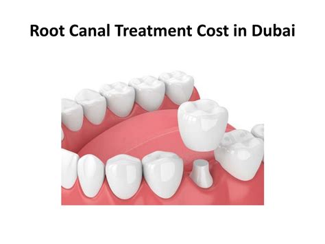 Ppt Root Canal Treatment Cost In Dubai Powerpoint Presentation Free