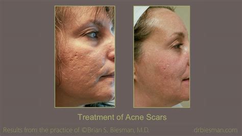 Scar Treatment Before and After Gallery | Nashville, TN