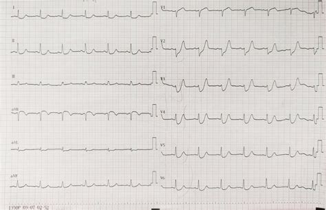 Emergency ECG showing de Winter ECG pattern | Download Scientific Diagram