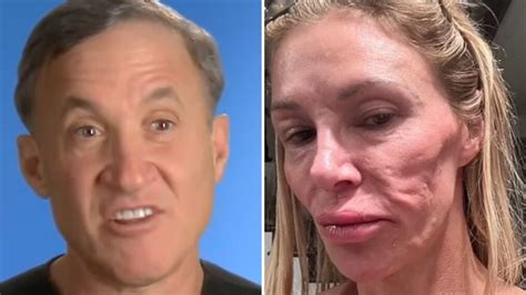 Botched Surgeon Dr Terry Dubrow Shares Views On Brandi Glanville S