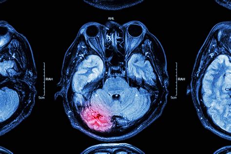 Tipos De Lesiones Cerebrales Traumáticas Lesiones Personales Sobo