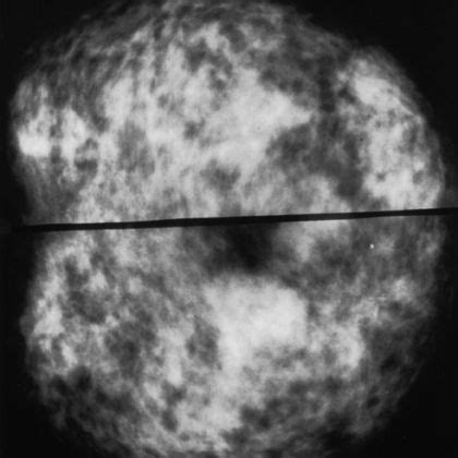 Mammogram Pictures of Normal and Abnormal Images