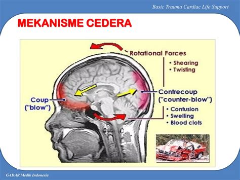 Cedera Kepala Ppt