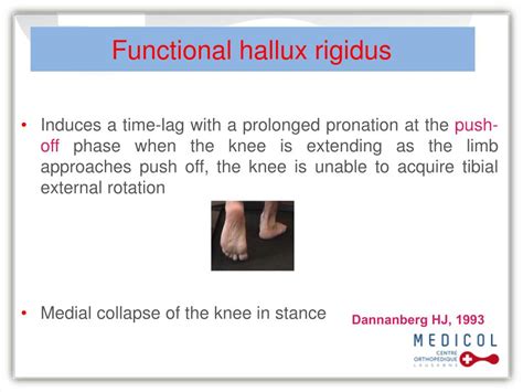 Ppt Functional Hallux Limitus Powerpoint Presentation Free Download Id 6377148