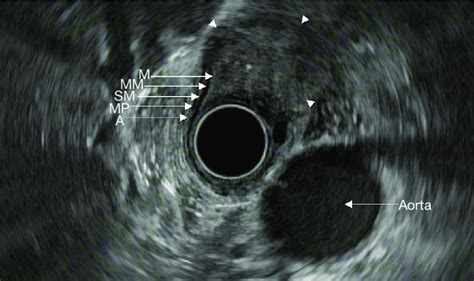 Endosonographic Image Revealing The Five Layers Of The Esophageal Wall Download Scientific