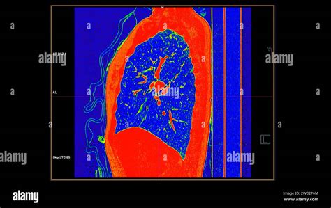 Ct Scan Of Chest Sagittal View In Color Mode For Diagnostic Pulmonary