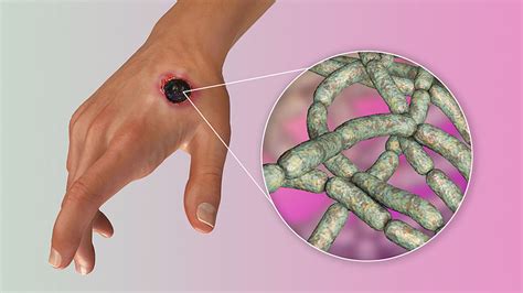 Principales formas de contagio y síntomas del ántrax