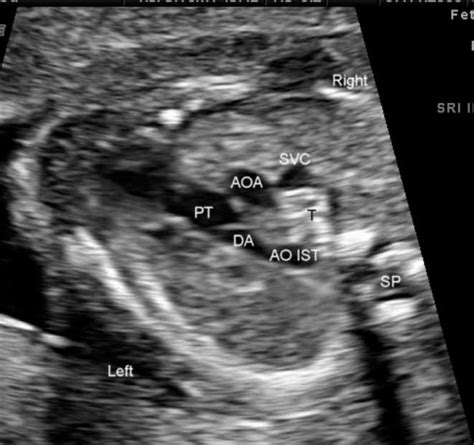 Subclavian Artery Ultrasound