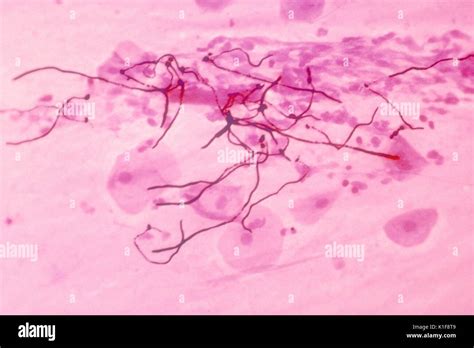 Candida Albicans Gram Stain