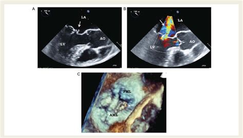 Perforation Of The Anterior Mitral Leaflet Arrow A Tee B Colour