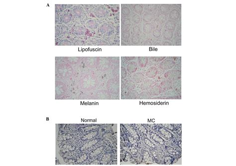 Histopathology Of Melanosis Coli And Determination Of Its Associated Genes By Comparative