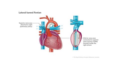 Fontan Procedure Diagram