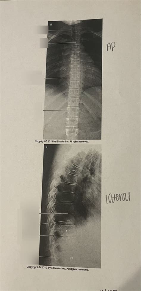 AP/Lateral Thoracic Vertebrae Xray Diagram | Quizlet