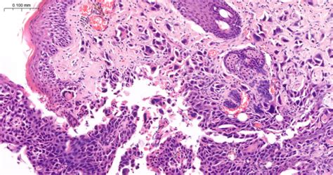 Squamous Papilloma With Squamous Cell Carcinoma In A Gerbil Veterinary Practice