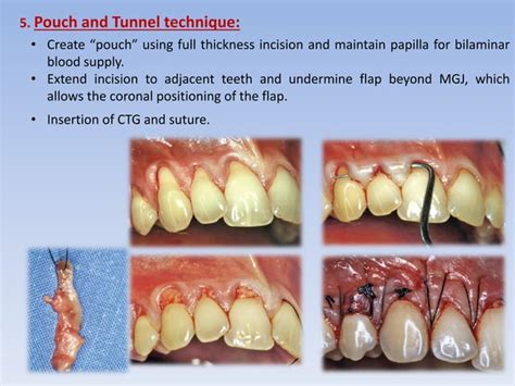 Mucogingival surgery | PPT