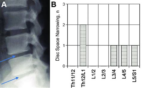 A Sagittal Radiograph Of Lumbar Spine Showing Disc Space Narrowing At