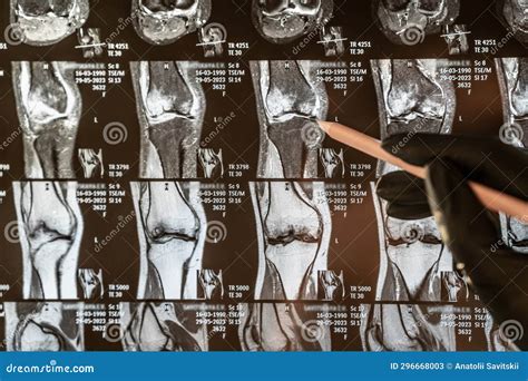 Magnetic Resonance Imaging Of Human Knee Joint For Medical Diagnosis