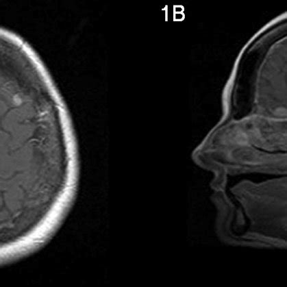 A) Small meningioma in the left frontal high convexity. B) At 1 year, a... | Download Scientific ...