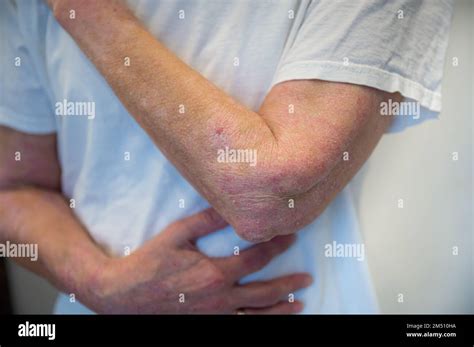 Skin Disease Psoriasis On Arm And Hand Stock Photo Alamy