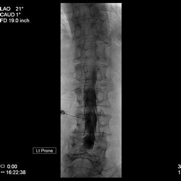 Myelography | My Doctor Online