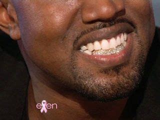 Did Kanye West Really Have His Teeth Pulled Out And Replaced With