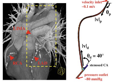 Post Operative Ct Scan Of The Complete Revascularization Procedure