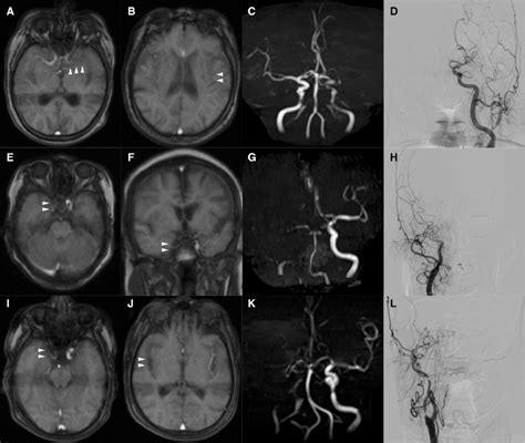 Illustrative Cases A D This Patient Presented With Right Hemiplegia